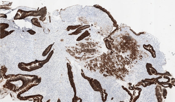 5x magnification of CLDN18-stained tumour sample with surrounding normal gastric glands.